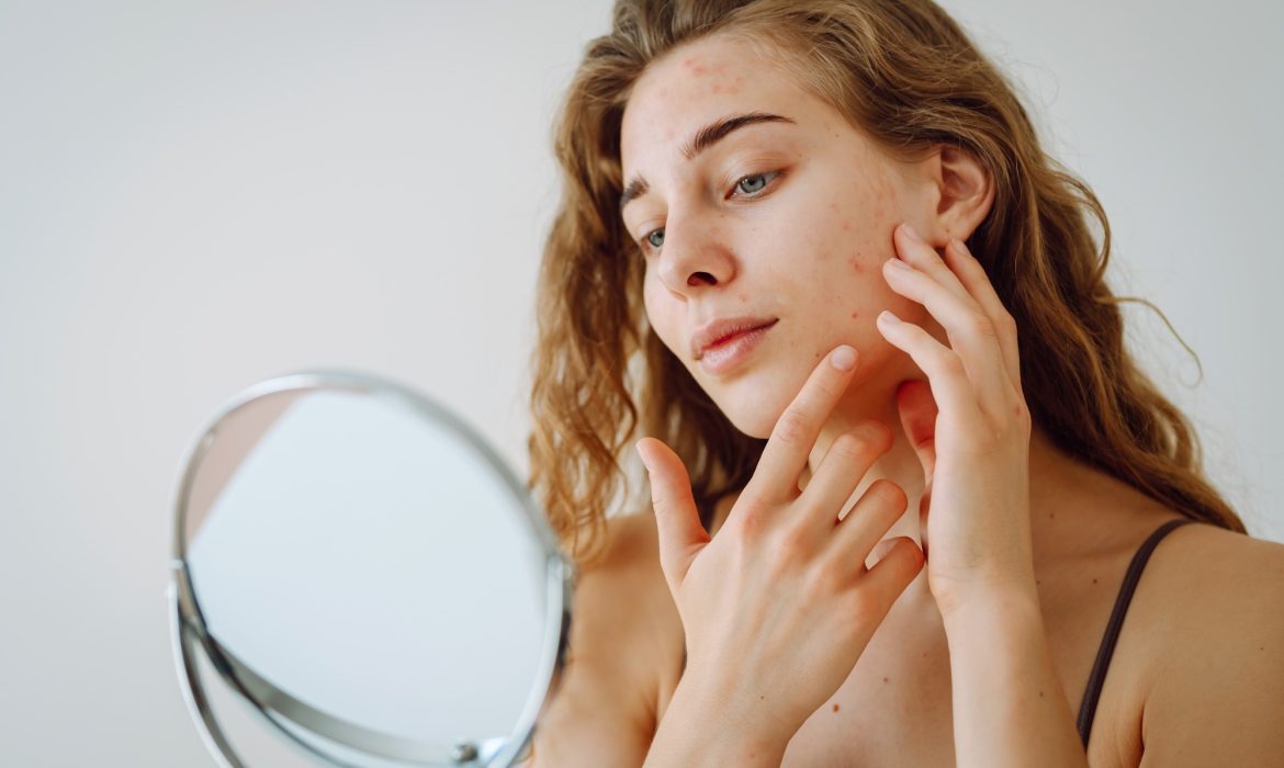 Close-up of a cute woman with problem skin looking in the mirror. Dermatology concept, allergy.